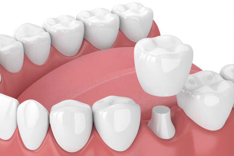 Dental Crowns in Westminster