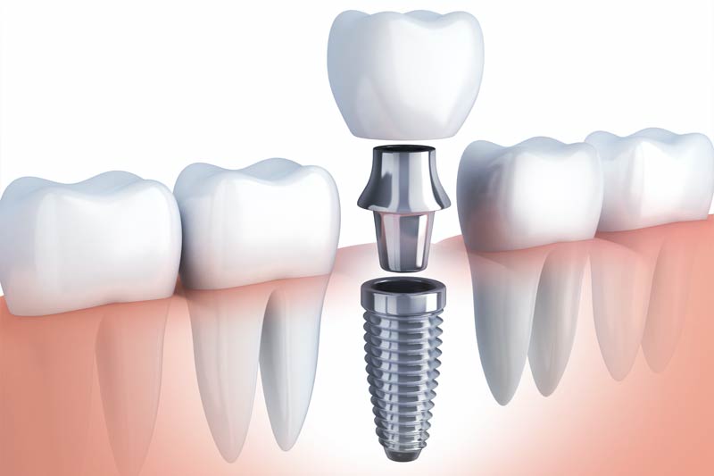 Implants Dentist in Westminster