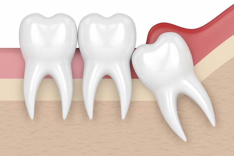 Wisdom Tooth Removal in Westminster